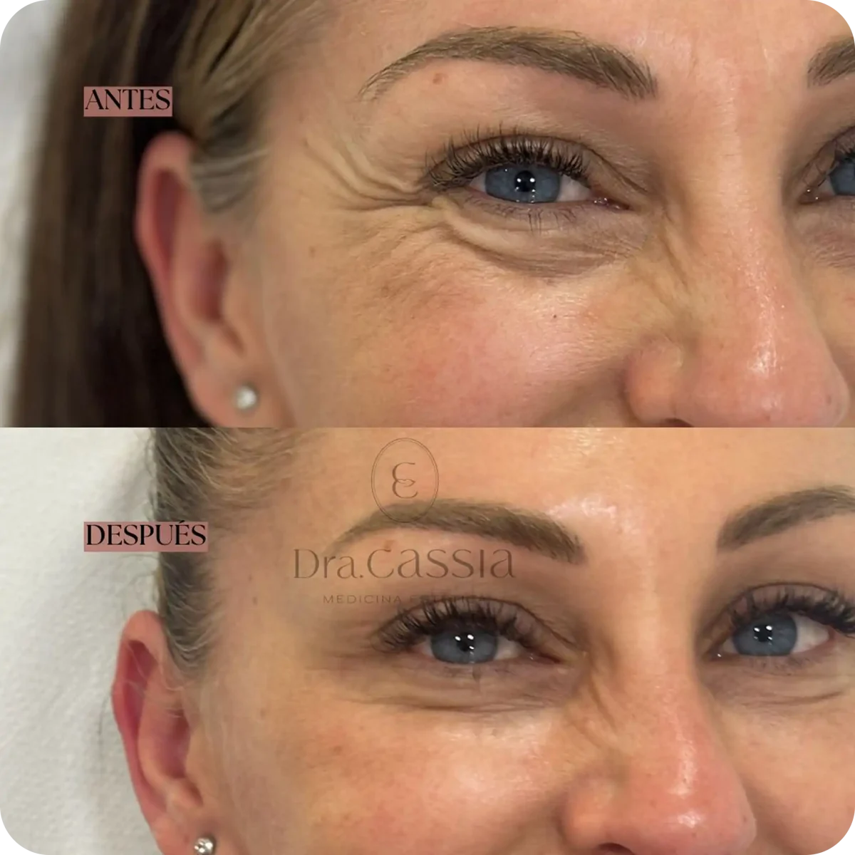 Dra. Cassia Castillo, Medicina Estética, Armonía, Salud, Autentecidad, Madrid, Avenida Felipe, España, Tratamiento Superior, Tratamiento Medio, Tratemiento Inferior, Tratamientos Corporales, Tratamiento Capilar, Tratamiento Corporales, especialista en embellecimiento y rejuvenecimiento facial. Olistic,