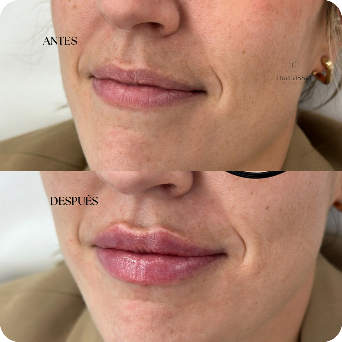 Dra. Cassia Castillo, Medicina Estética, Armonía, Salud, Autentecidad, Madrid, Avenida Felipe, España, Tratamiento Superior, Tratamiento Medio, Tratemiento Inferior, Tratamientos Corporales, Tratamiento Capilar, Tratamiento Corporales, especialista en embellecimiento y rejuvenecimiento facial. Olistic,