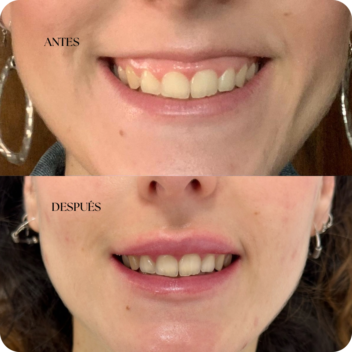 Dra. Cassia Castillo, Medicina Estética, Armonía, Salud, Autentecidad, Madrid, Avenida Felipe, España, Tratamiento Superior, Tratamiento Medio, Tratemiento Inferior, Tratamientos Corporales, Tratamiento Capilar, Tratamiento Corporales, especialista en embellecimiento y rejuvenecimiento facial. Olistic,