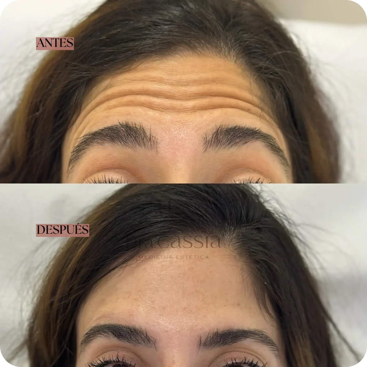 Dra. Cassia Castillo, Medicina Estética, Armonía, Salud, Autentecidad, Madrid, Avenida Felipe, España, Tratamiento Superior, Tratamiento Medio, Tratemiento Inferior, Tratamientos Corporales, Tratamiento Capilar, Tratamiento Corporales, especialista en embellecimiento y rejuvenecimiento facial. Olistic,