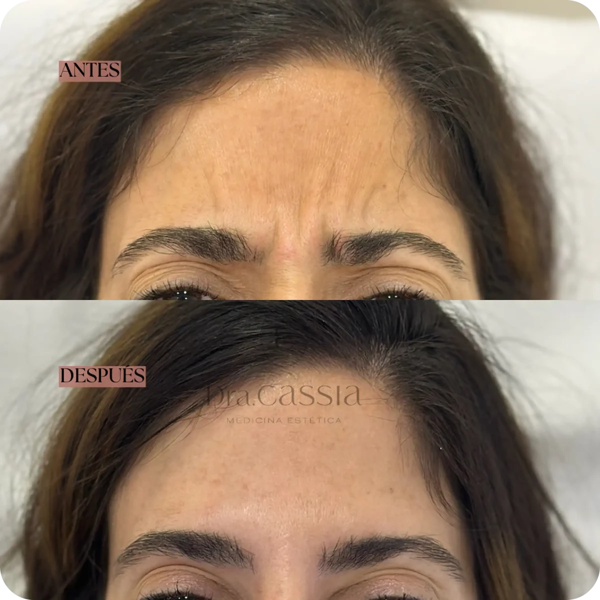 Dra. Cassia Castillo, Medicina Estética, Armonía, Salud, Autentecidad, Madrid, Avenida Felipe, España, Tratamiento Superior, Tratamiento Medio, Tratemiento Inferior, Tratamientos Corporales, Tratamiento Capilar, Tratamiento Corporales, especialista en embellecimiento y rejuvenecimiento facial. Olistic,