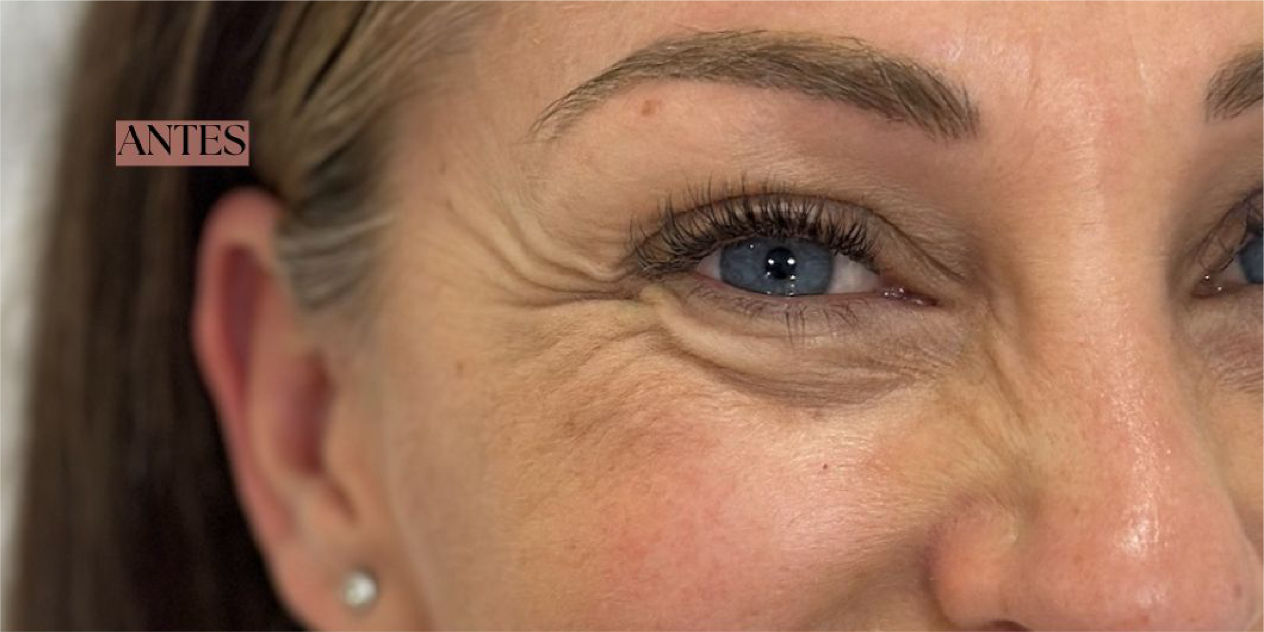 Dra. Cassia Castillo, Medicina Estética, Armonía, Salud, Autentecidad, Madrid, Avenida Felipe, España, Tratamiento Superior, Tratamiento Medio, Tratemiento Inferior, Tratamientos Corporales, Tratamiento Capilar, Tratamiento Corporales, especialista en embellecimiento y rejuvenecimiento facial. Olistic,