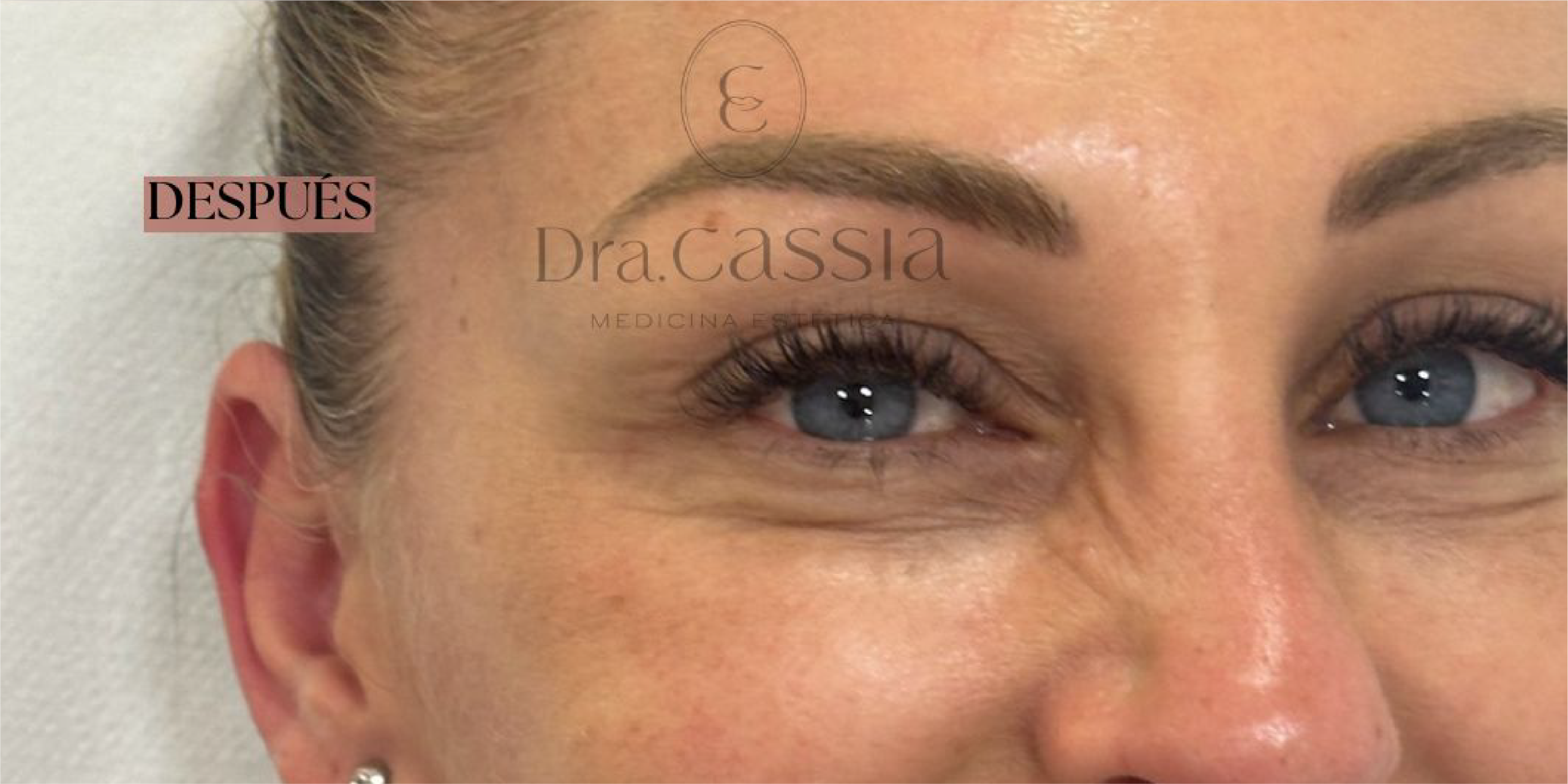 Dra. Cassia Castillo, Medicina Estética, Armonía, Salud, Autentecidad, Madrid, Avenida Felipe, España, Tratamiento Superior, Tratamiento Medio, Tratemiento Inferior, Tratamientos Corporales, Tratamiento Capilar, Tratamiento Corporales, especialista en embellecimiento y rejuvenecimiento facial. Olistic,